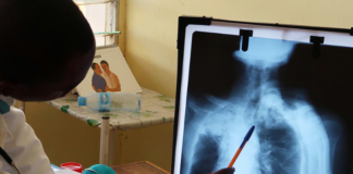 tuberculosis niños pediatría venezuela