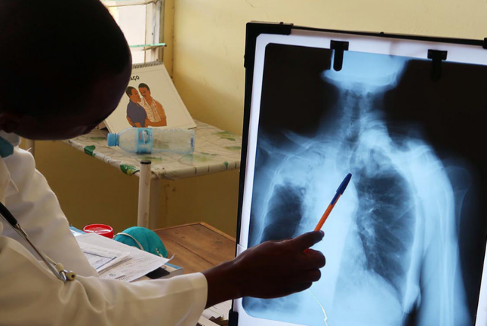 tuberculosis niños pediatría venezuela